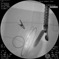 R&ouml;ntgen Pseudozyste mit Draht und Dilatation | fluoroscopy pseudocyst with guide wire and dilation