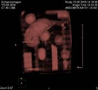 CT Scan des LET | CT scan of LET
